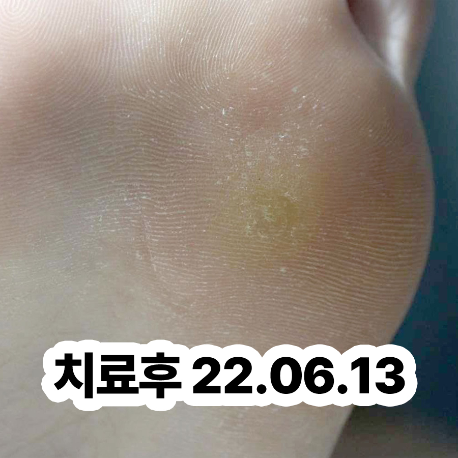 분당 편평사마귀 병원 성지 관련 이미지 3