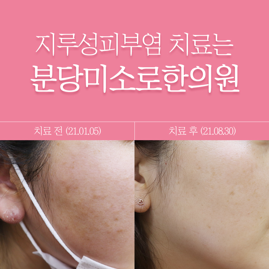 여주 지루성 피부염 피부과 명의 관련 이미지 1