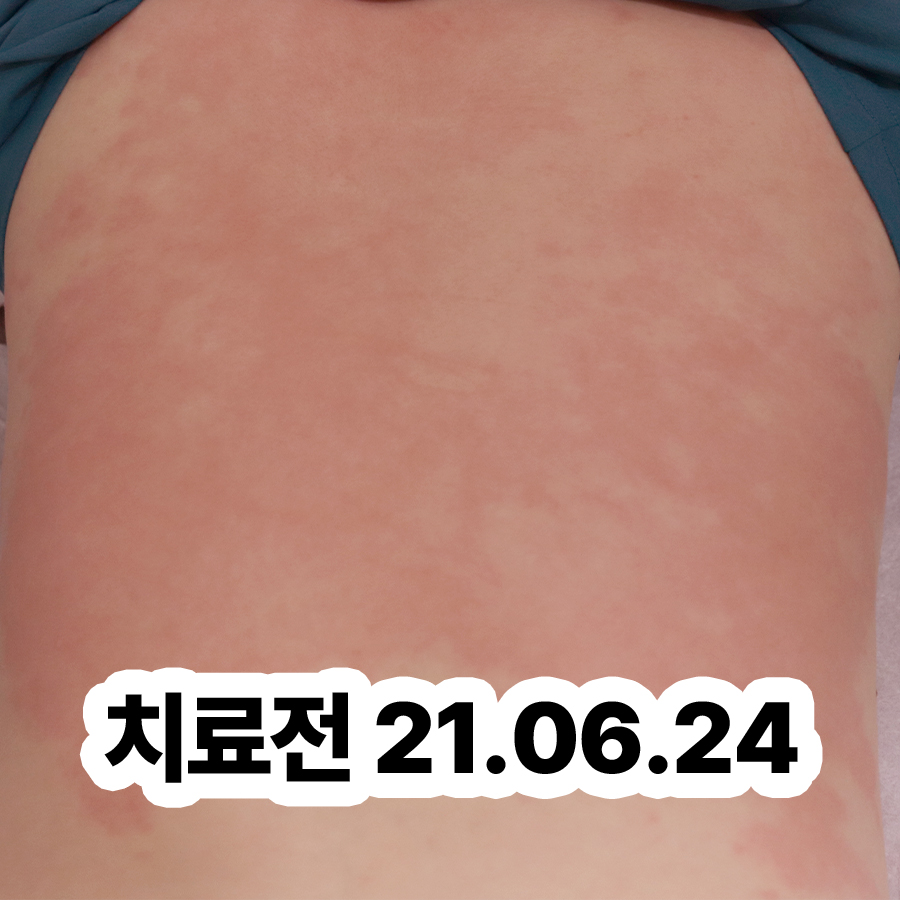 분당 얼굴 알러지 두드러기 관련 이미지 2