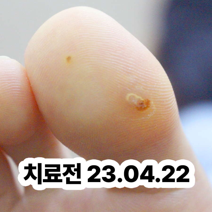 분당 물사마귀 없애는 법 관련 이미지 2