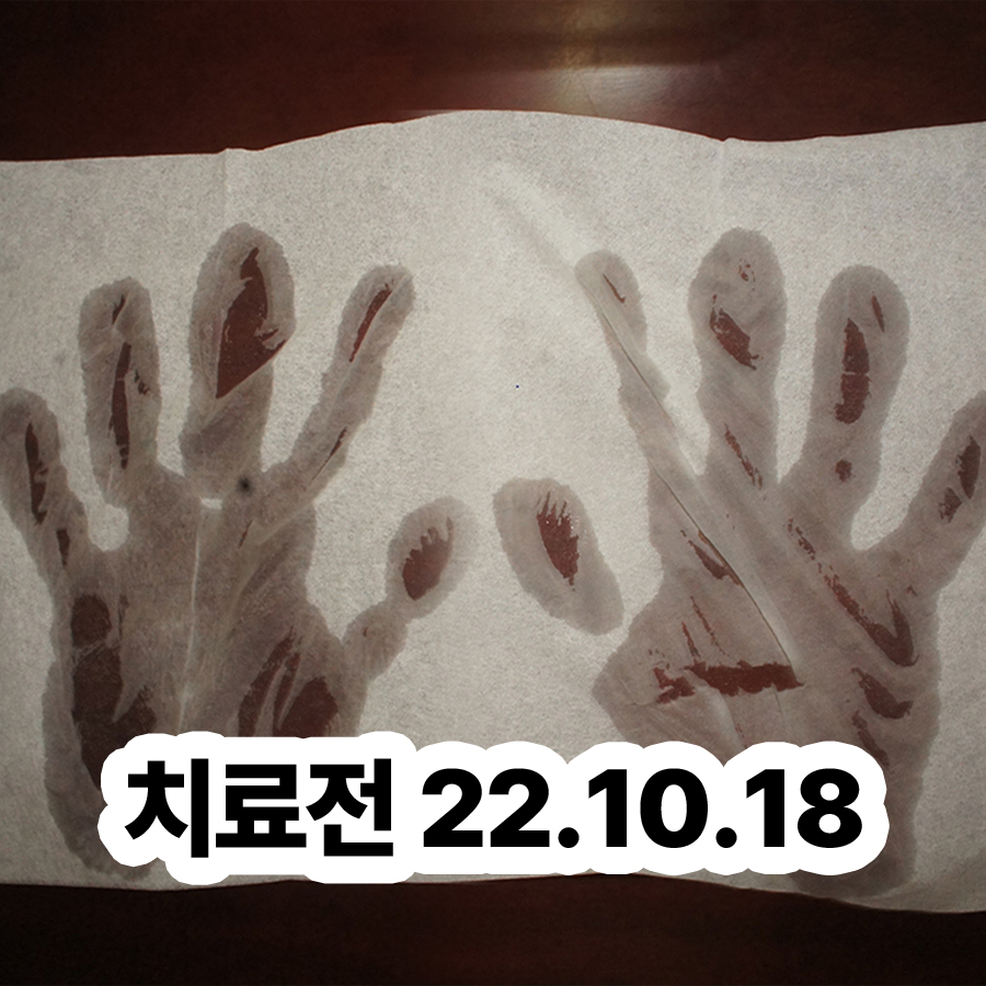 분당 수족다한증병원 관련 이미지 2