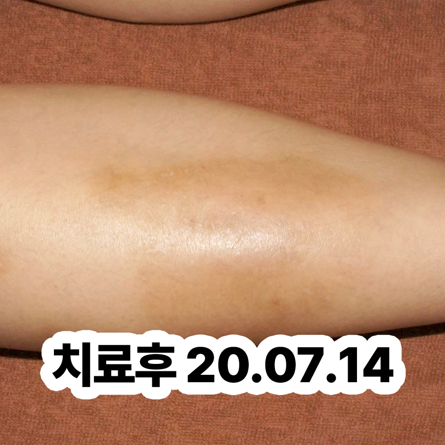 경기광주 만성 주부습진 치료 관련 이미지 3
