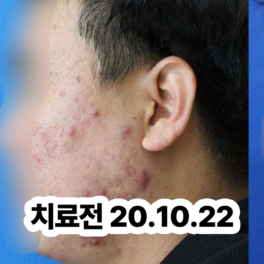 분당 지루성피부염 치료 관련 이미지 2