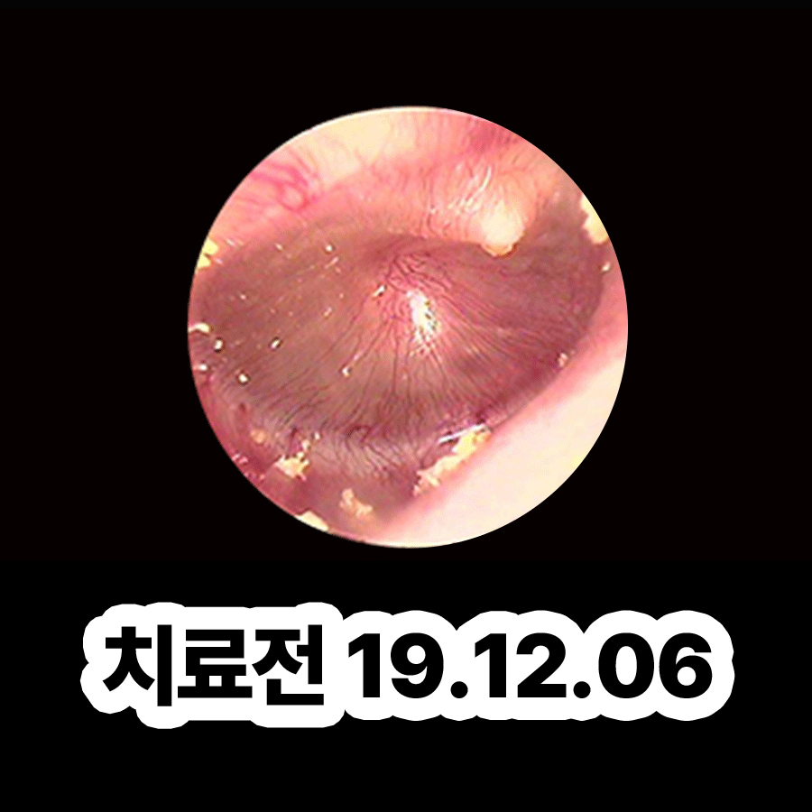 분당 중이염 약 안 먹고 관련 이미지 2