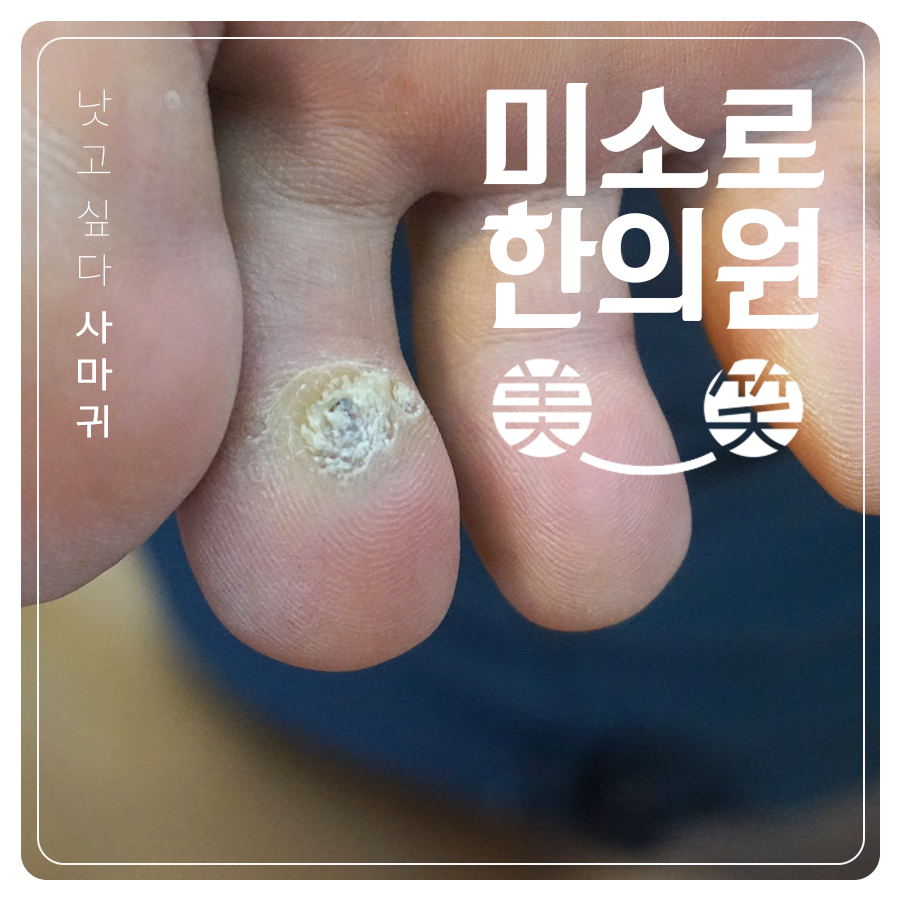 분당 사마귀한방치료 관련 이미지 1