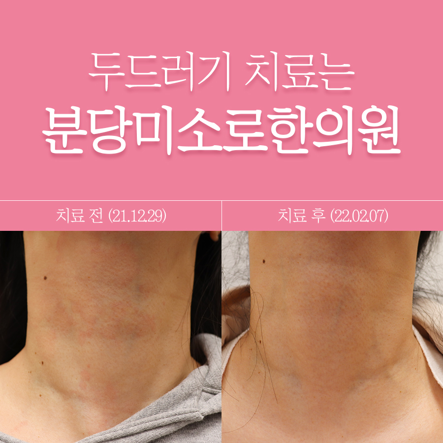 분당 두드러기 병원 관련 이미지 1