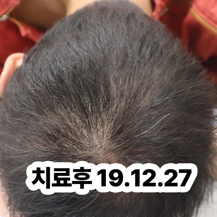 성남 두피 건선 치료 피부과 관련 이미지 3
