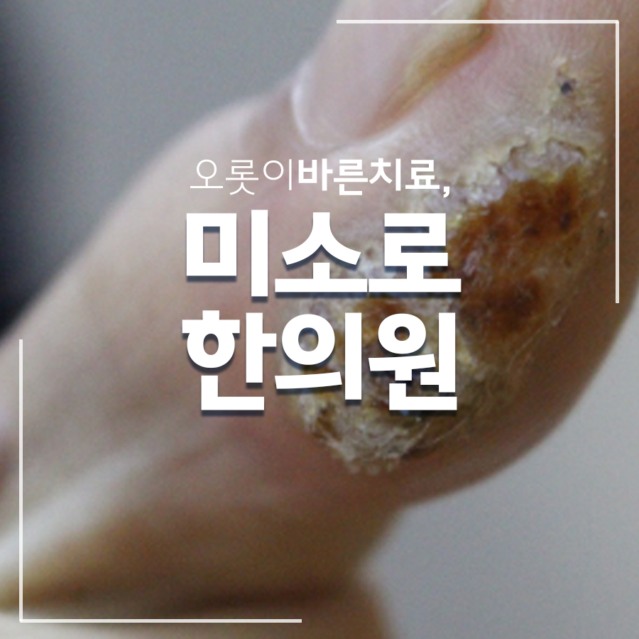 용인 몸 사마귀 관련 이미지 1