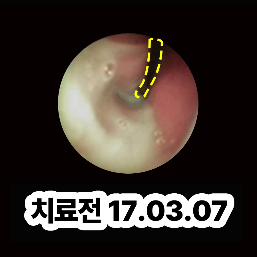 성남 부비동염 치료기간 관련 이미지 2