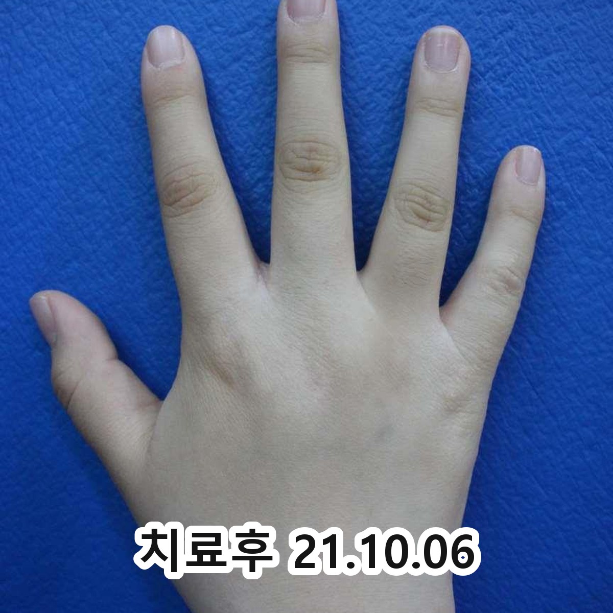성남 화폐상 습진 치료 방법 관련 이미지 3
