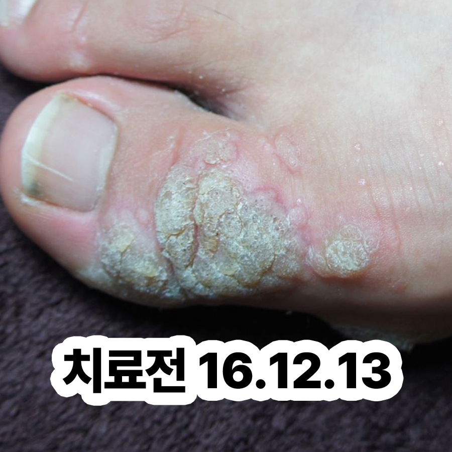 분당 사마귀 한의원 관련 이미지 2