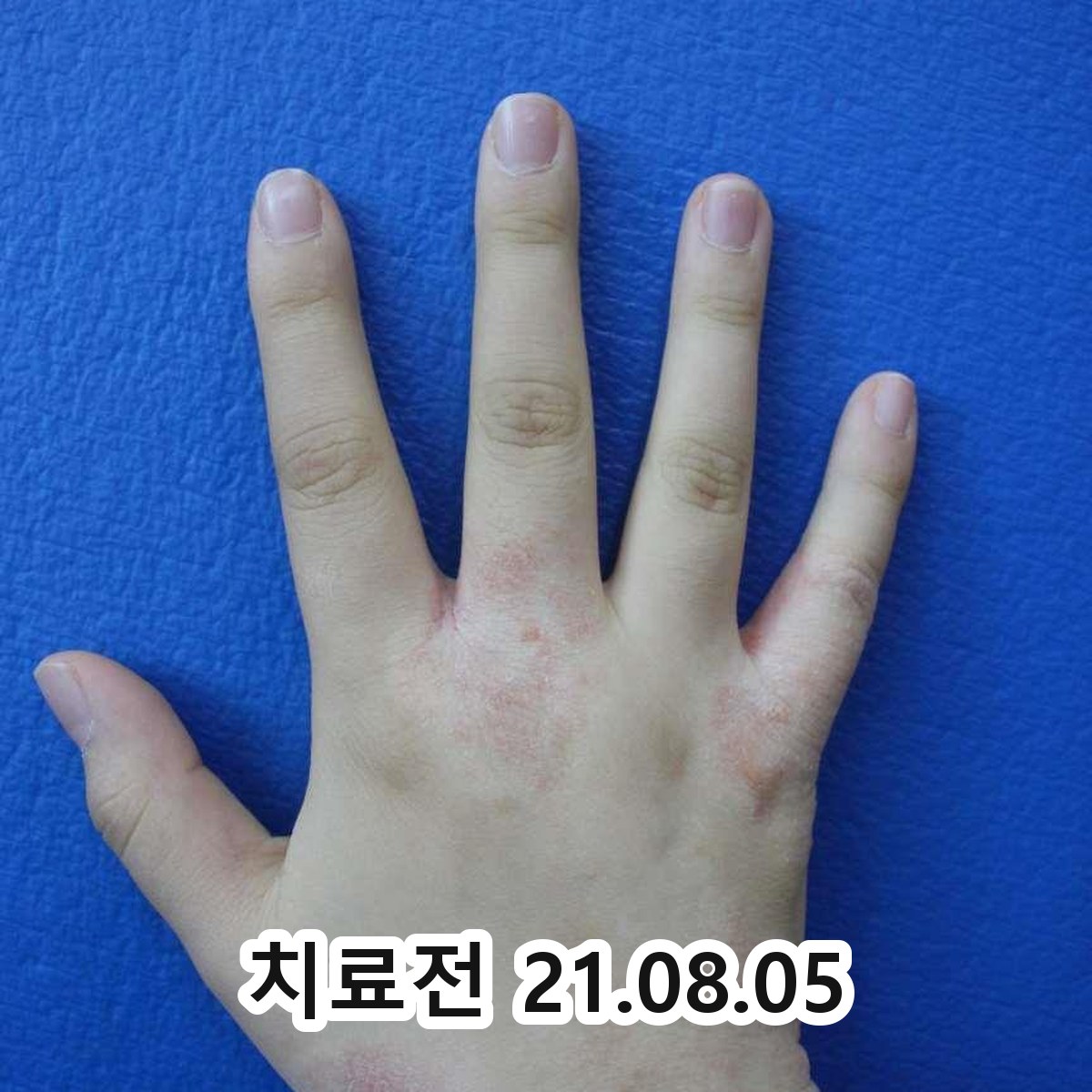 성남 화폐상 습진 치료 방법 관련 이미지 2