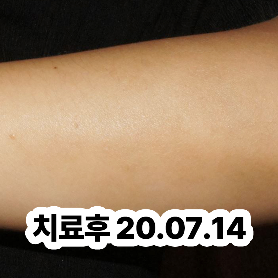 용인 발 습진 치료 병원 관련 이미지 3