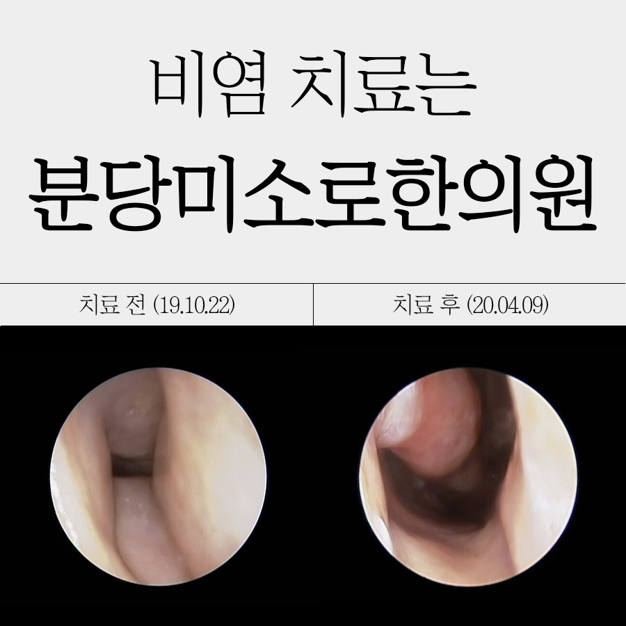 분당 알레르기 비염 치료제 관련 이미지 1
