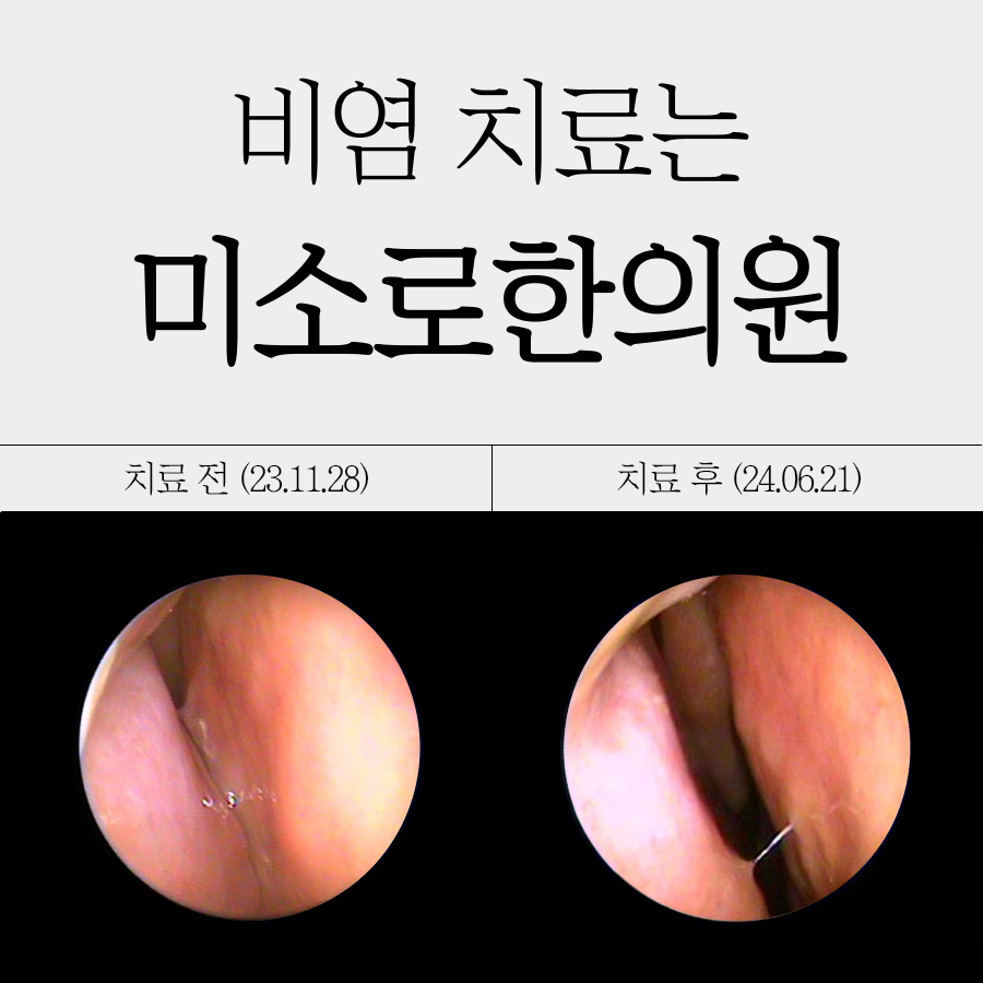 정자역 비염수술 병원비교 관련 이미지 1