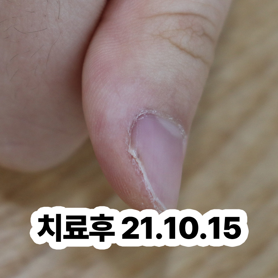 분당 발가락 사마귀 치료 방법 관련 이미지 3