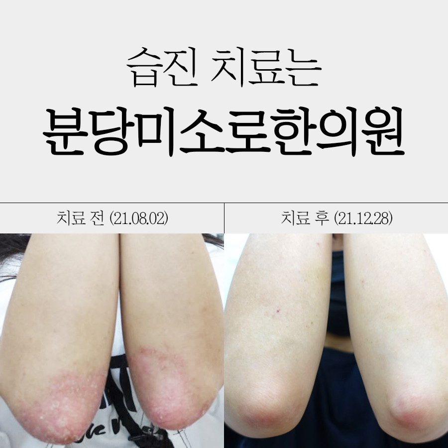 분당 화폐성 습진 치료방법 관련 이미지 1