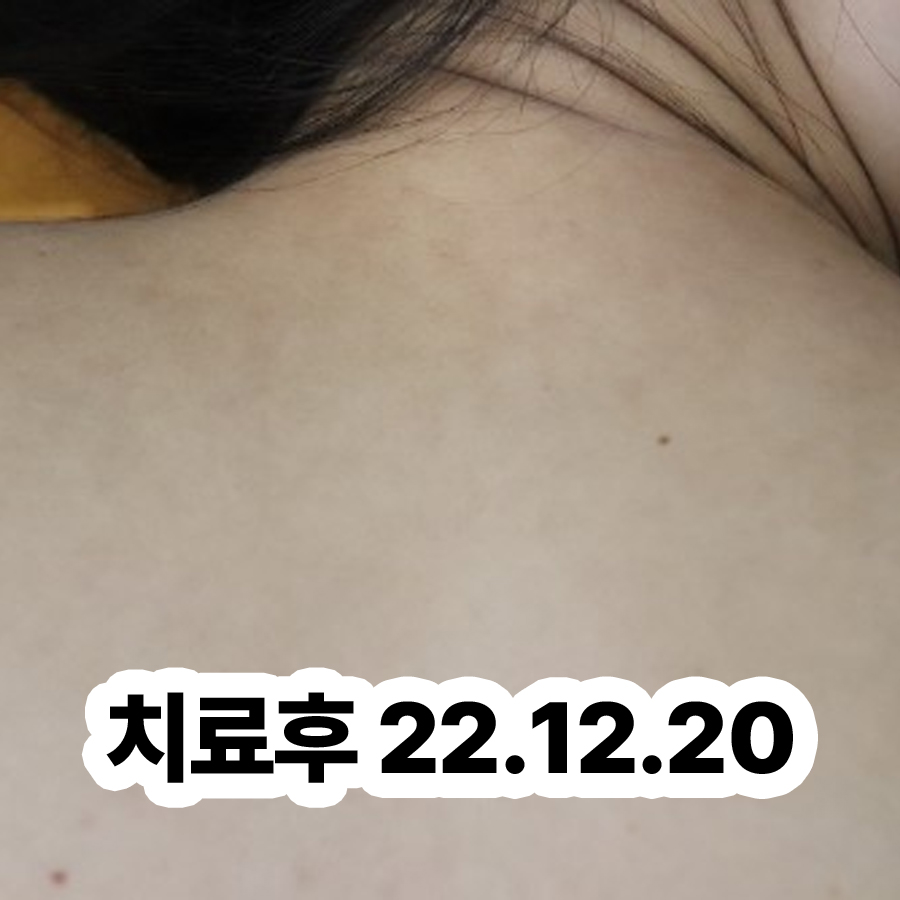 위례 사타구니 습진 병원 어디로 관련 이미지 3