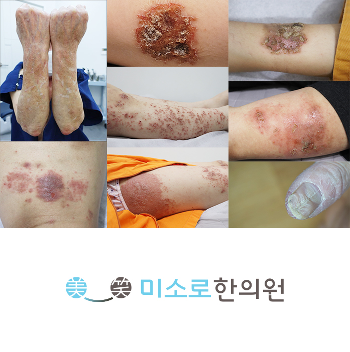 분당 사타구니 습진 병원 어디로 관련 이미지 1
