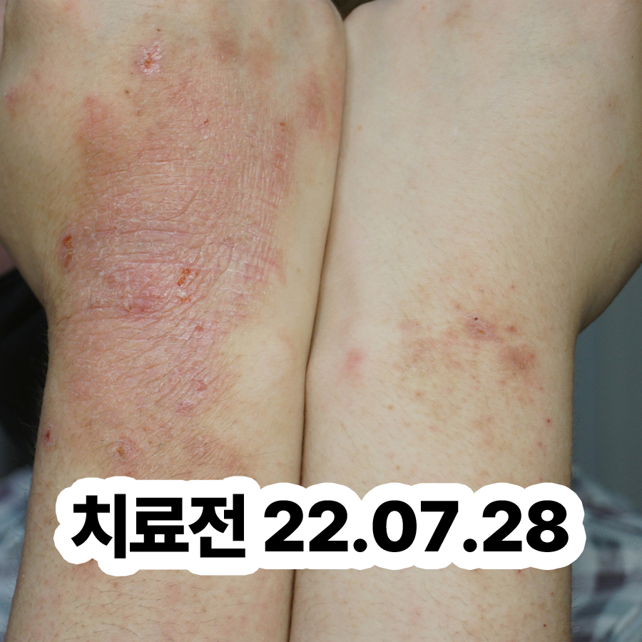 분당 아토피 치료제 관련 이미지 2