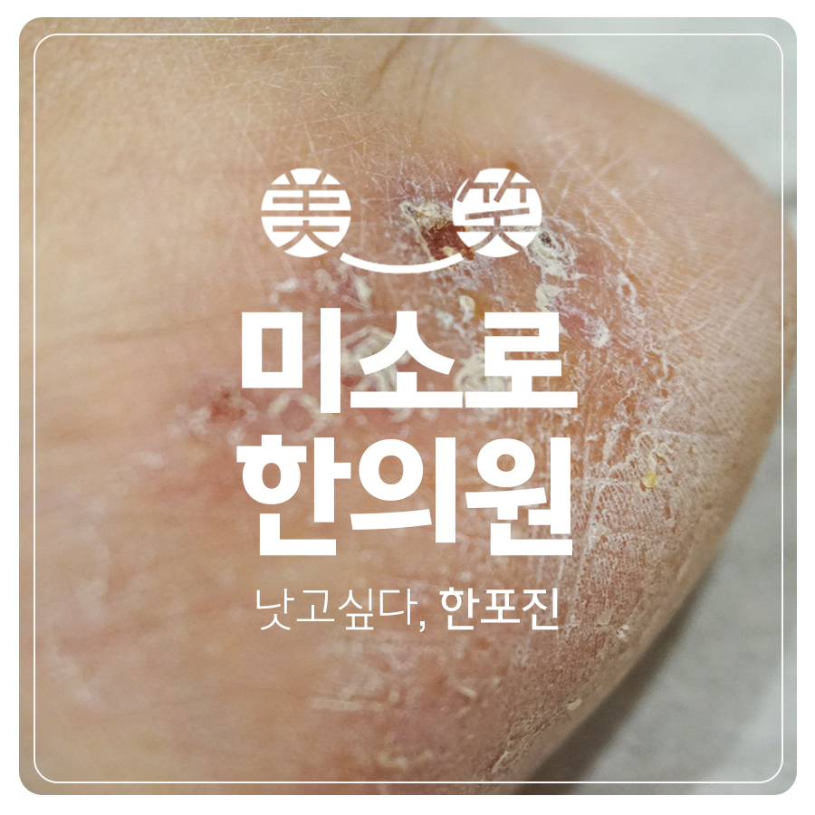 발 한포진 병원