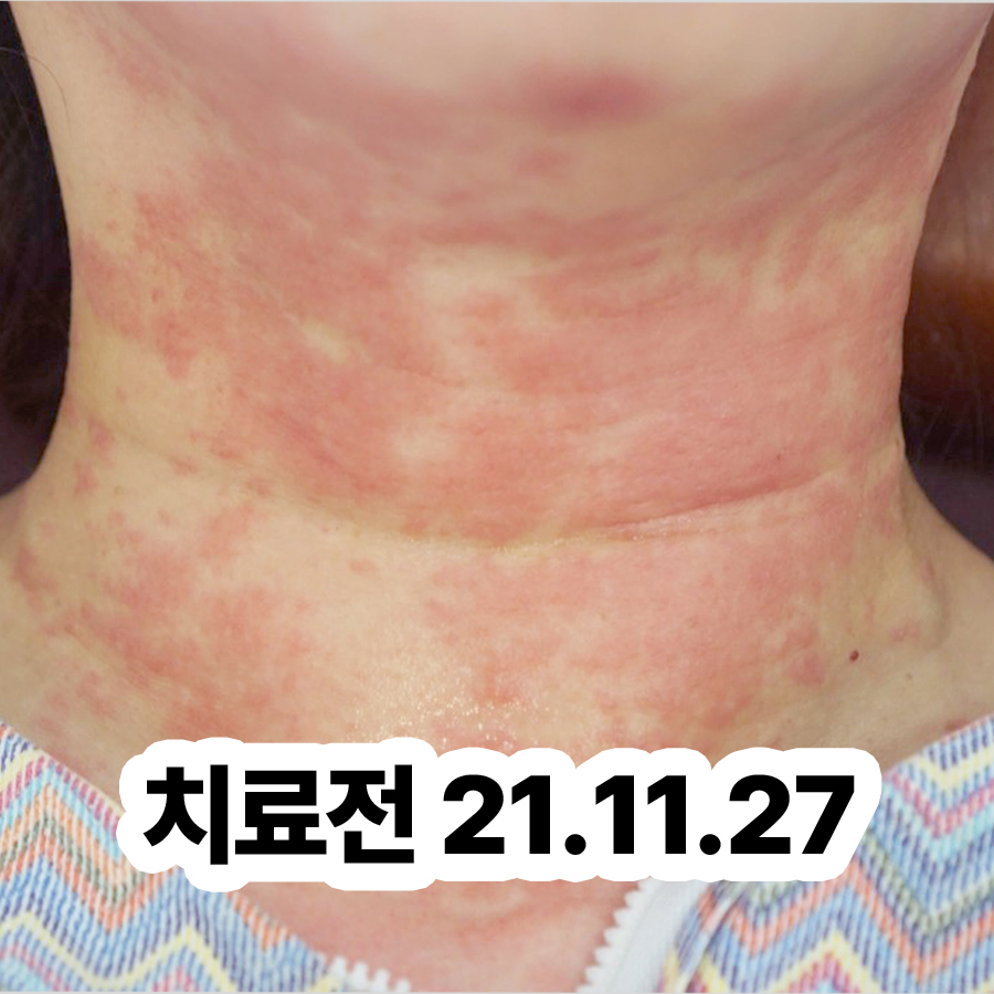 분당 피부 두드러기 병원 어디로 관련 이미지 2