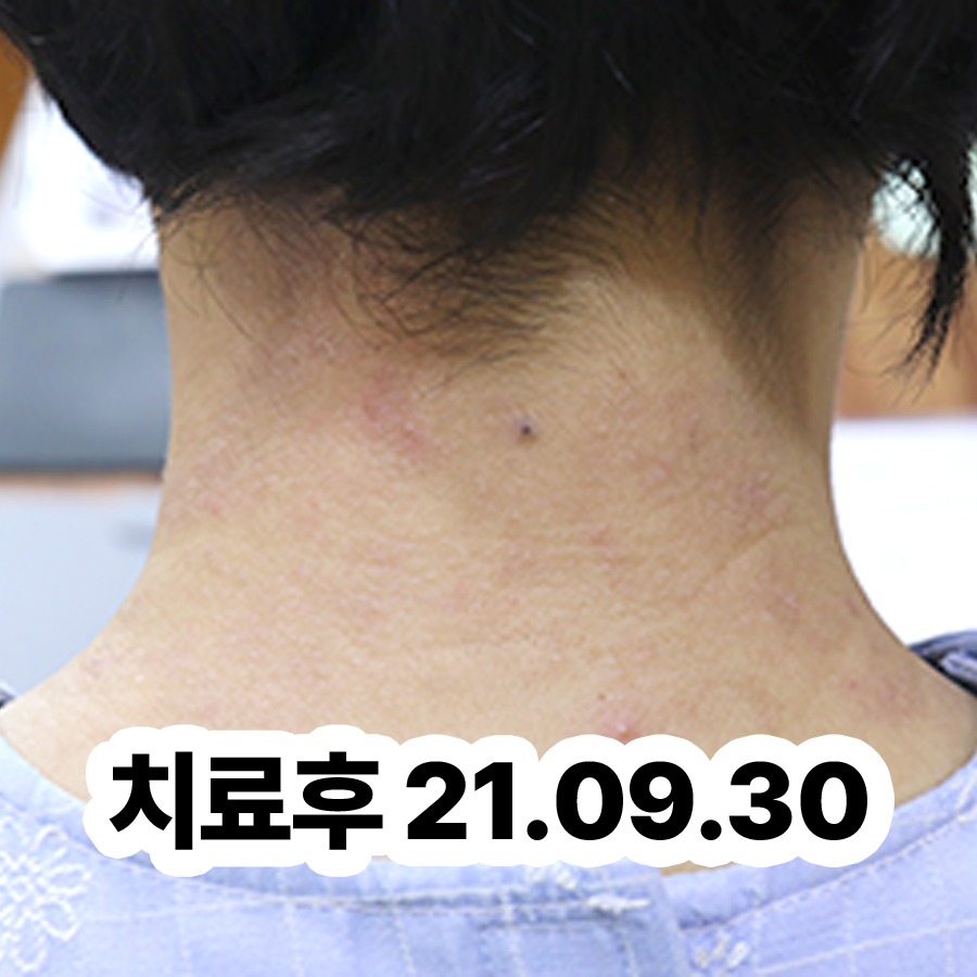 분당 성인아토피치료방법 관련 이미지 3