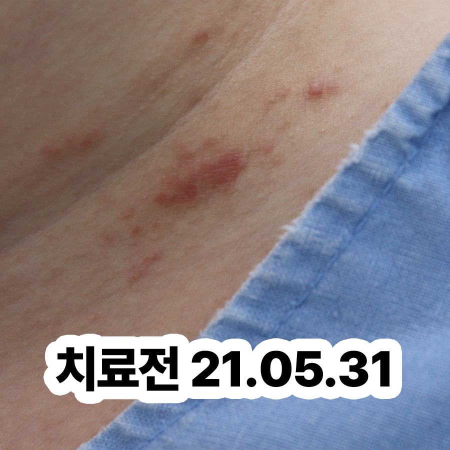 경기광주 지루성피부염 병원 추천 관련 이미지 2