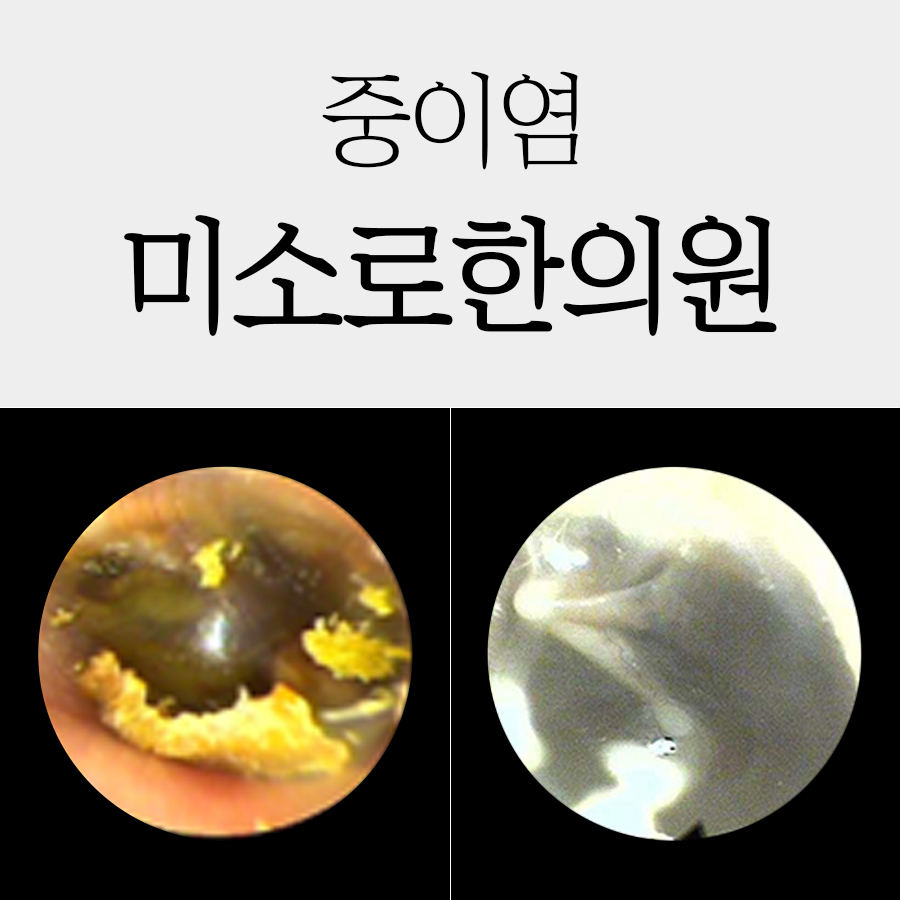 여주 중이염 치료기간 관련 이미지 1