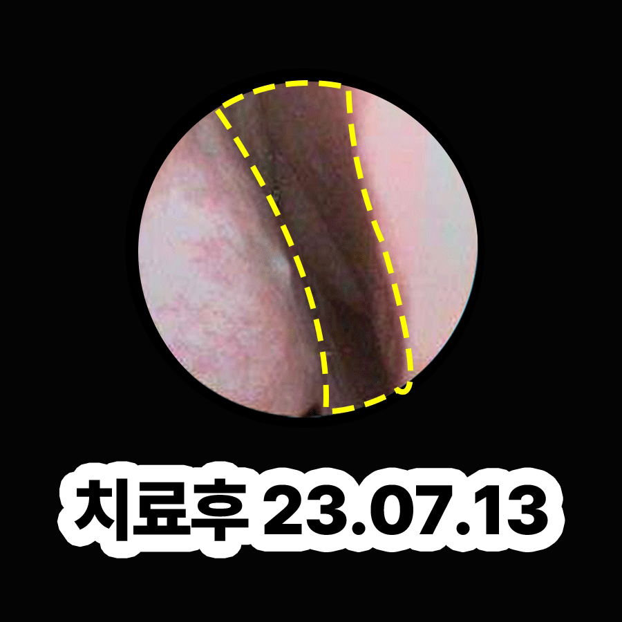 분당 축농증증세 관련 이미지 3