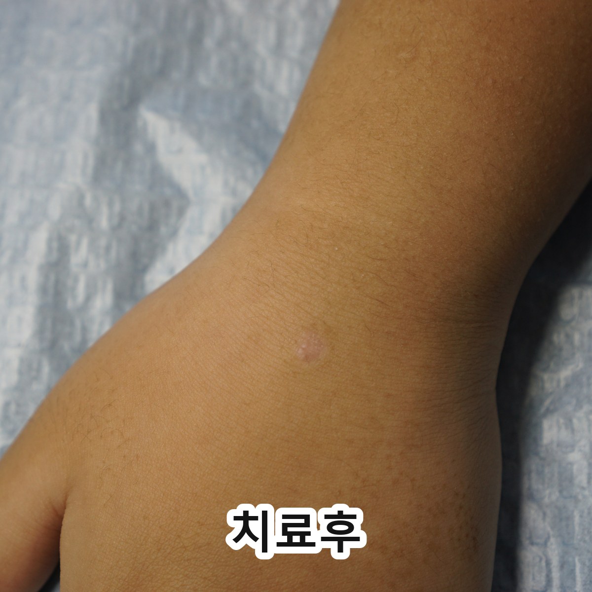 분당 손등 편평사마귀 살리실산 관련 이미지 3