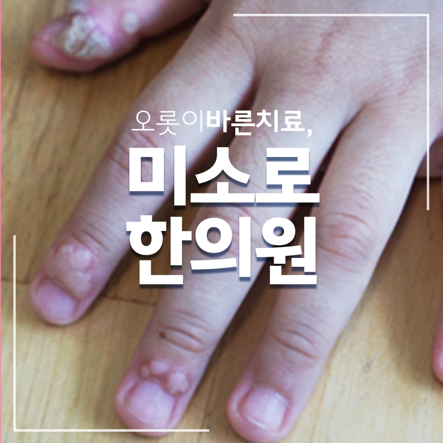 광명 편평사마귀 완치후기입니다
