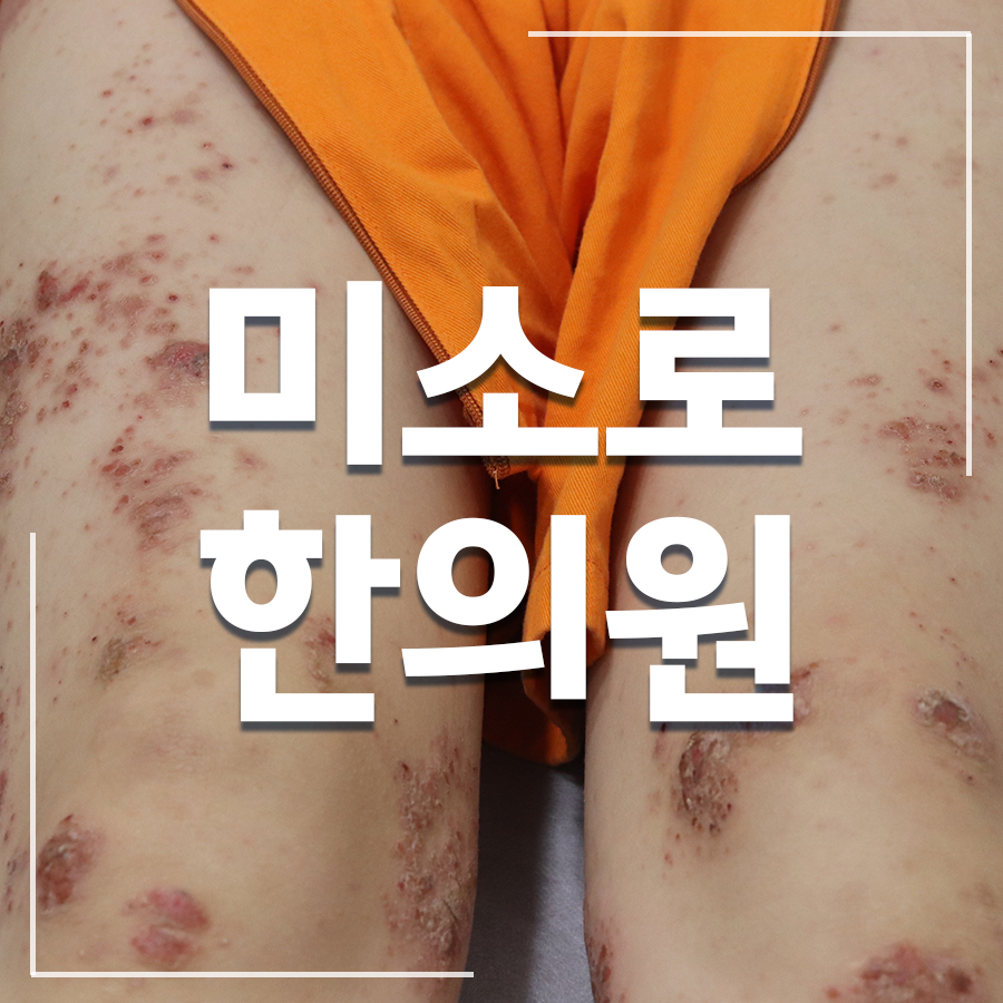 정자역 습진 가려움 이유 관련 이미지 1