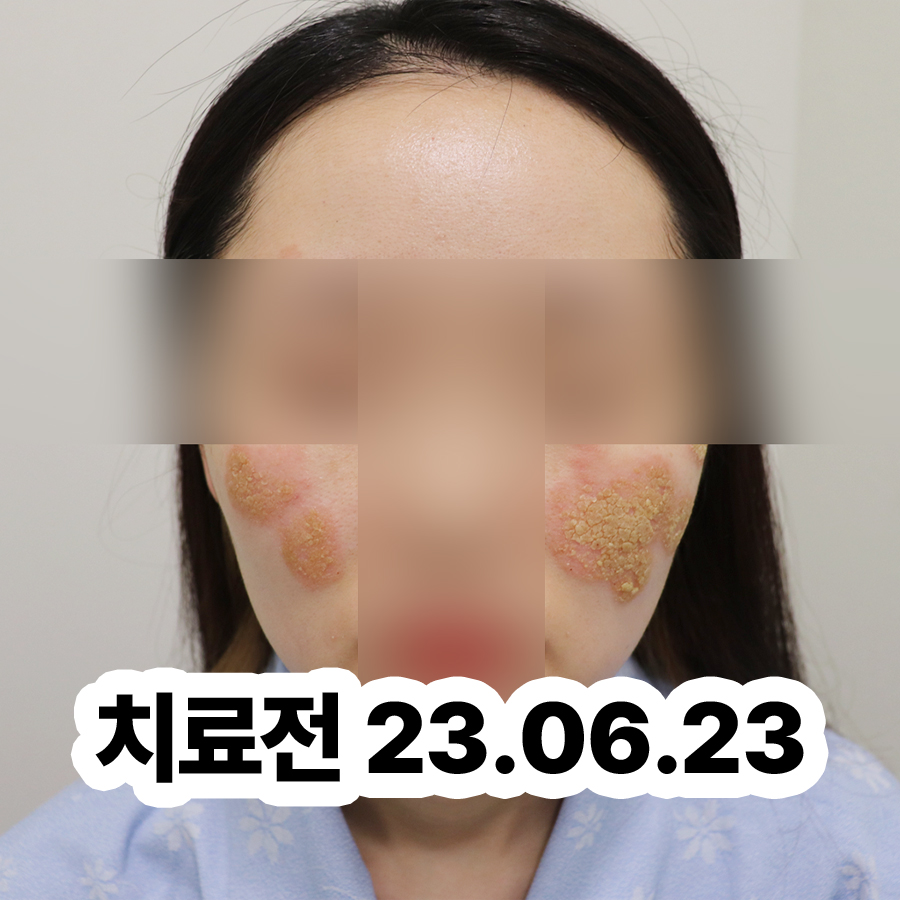 분당 남자 사타구니 습진 착색 관련 이미지 2