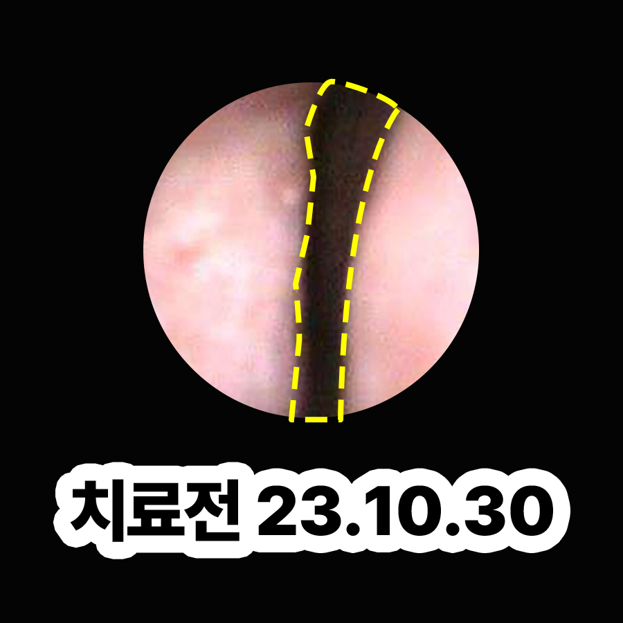 분당 한의원 비염 치료 효과 관련 이미지 2