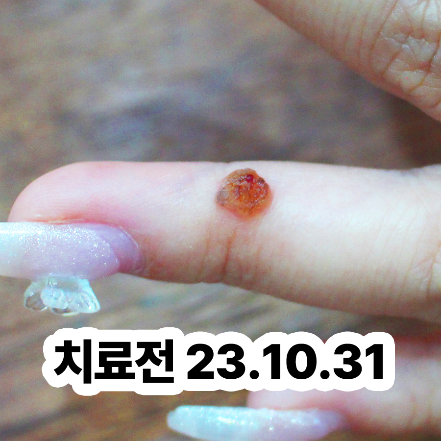 분당 물사마귀피부과 관련 이미지 2