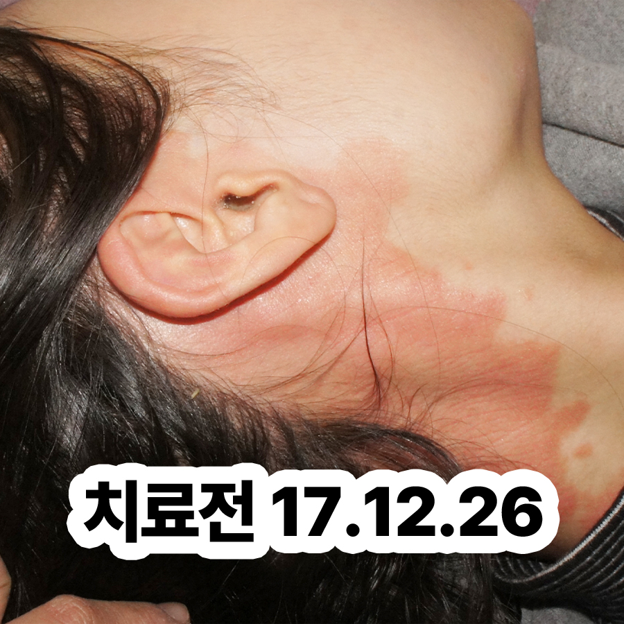 분당 건선피부치료 관련 이미지 2