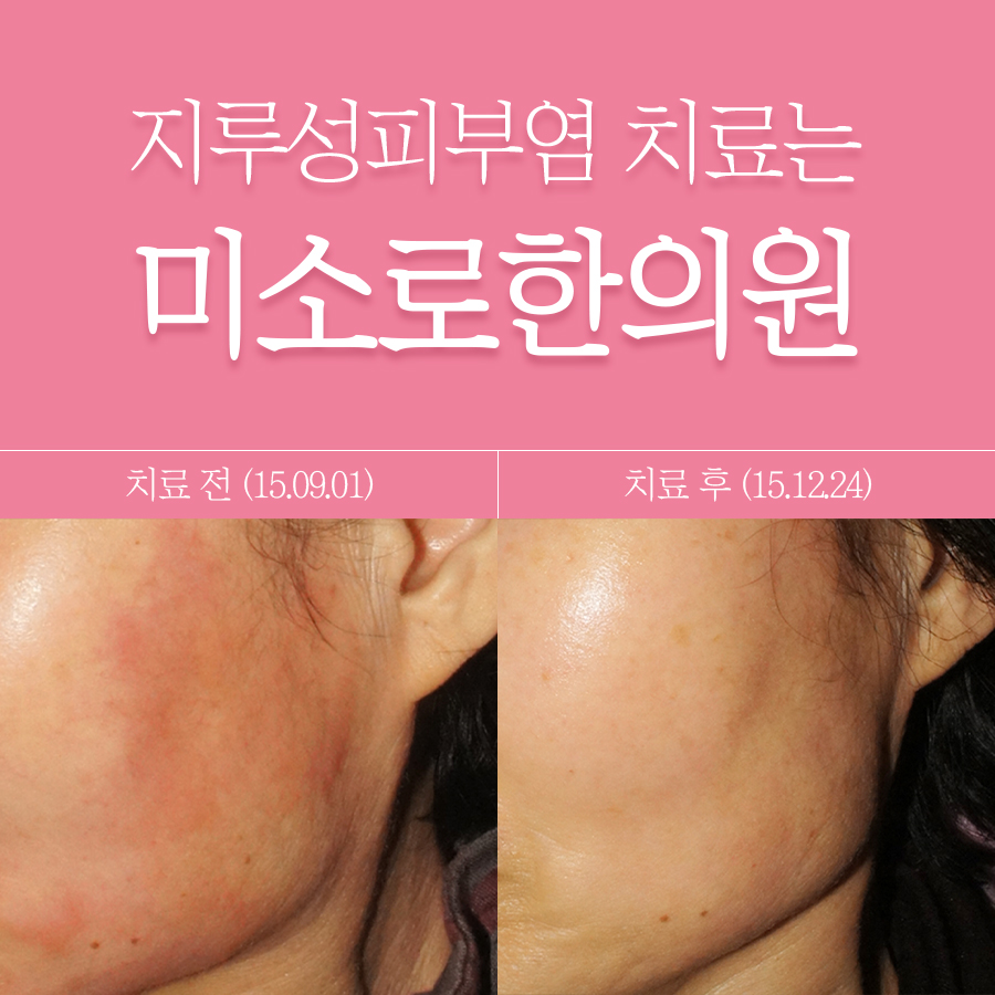 분당 지루성피부염 한의원 관련 이미지 1