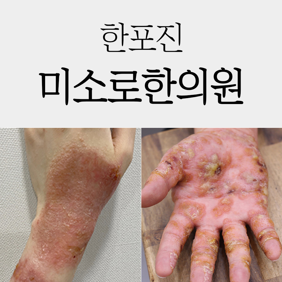경기광주 발바닥 한포진 치료 병원 관련 이미지 1