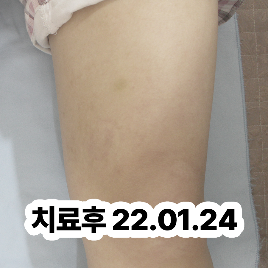 분당 알레르기 두드러기 병원 어디로 관련 이미지 3