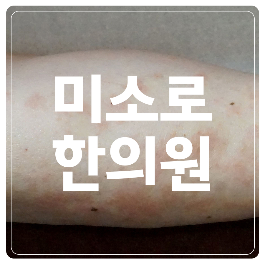여주 피부묘기증 원인 관련 이미지 1