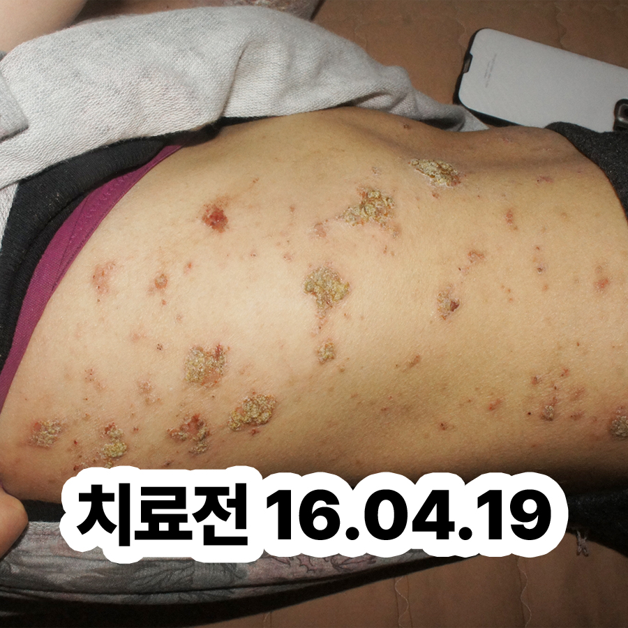 분당 습진 보습제 추천 관련 이미지 2
