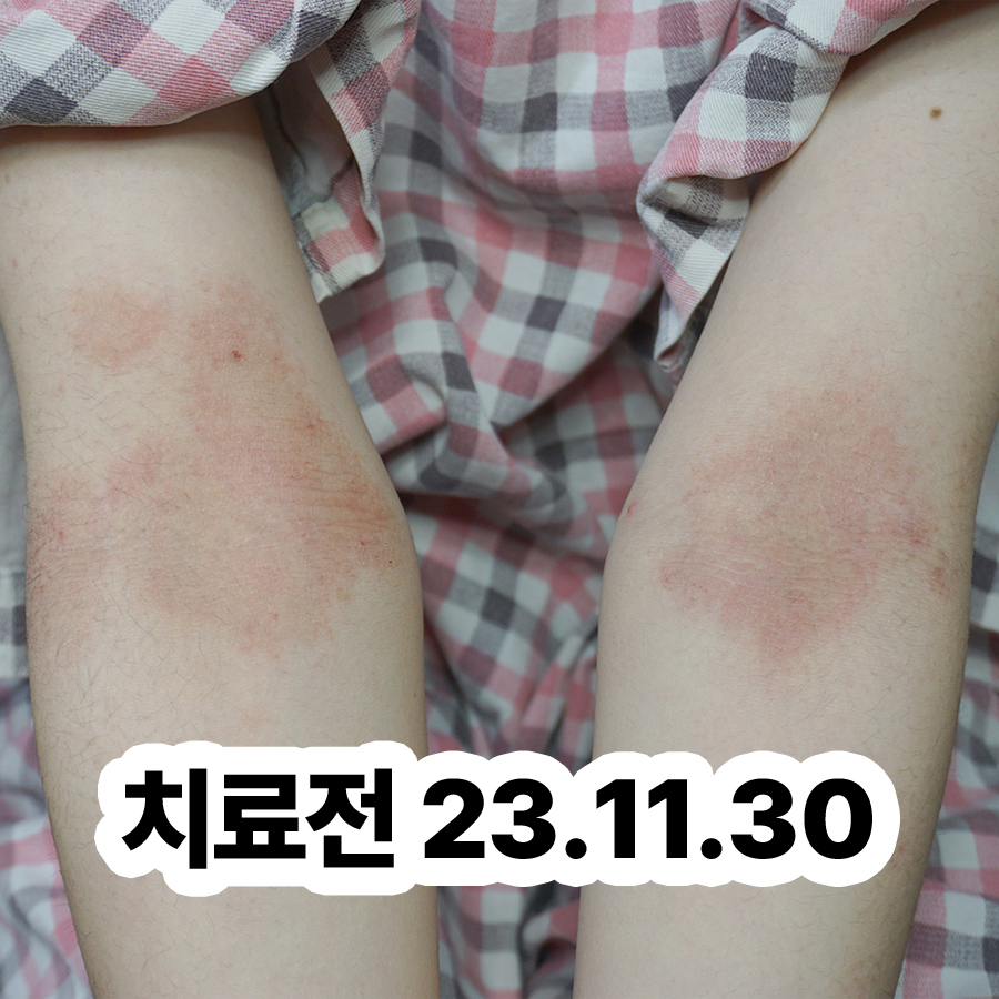 경기광주 성인 아토피 치료제 관련 이미지 2