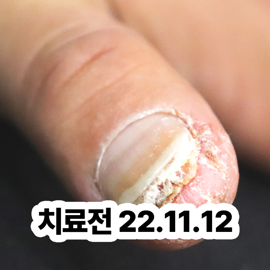 분당 목 사마귀 제거 후기 관련 이미지 2