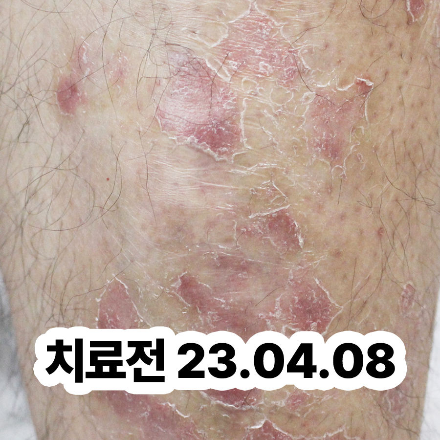 판교 피부 건선 치료법 관련 이미지 2