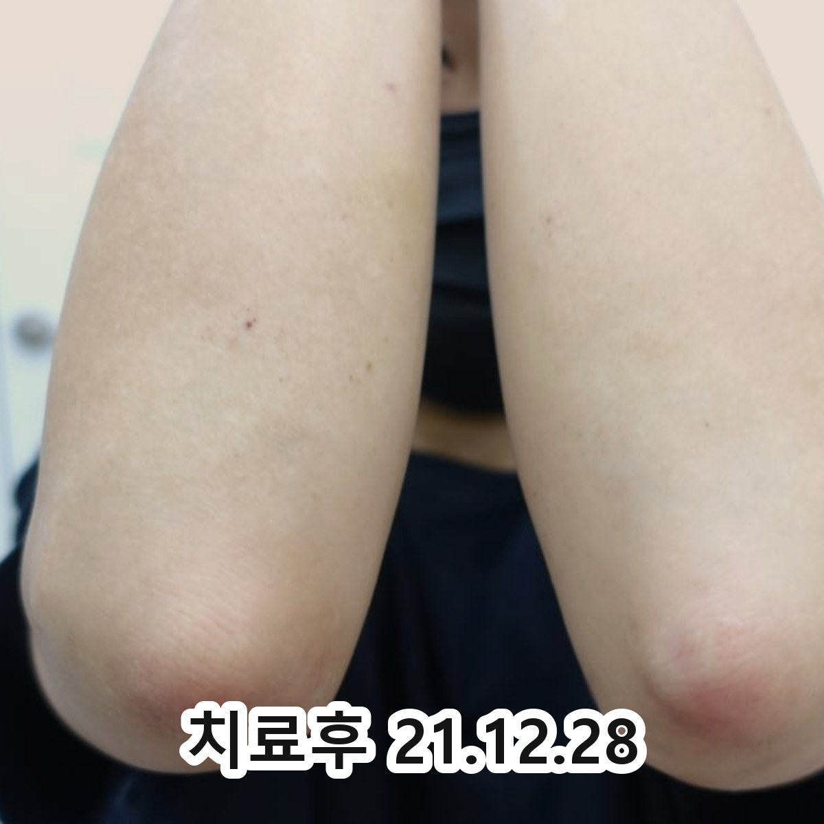 분당 유아 습진 연고 관련 이미지 3