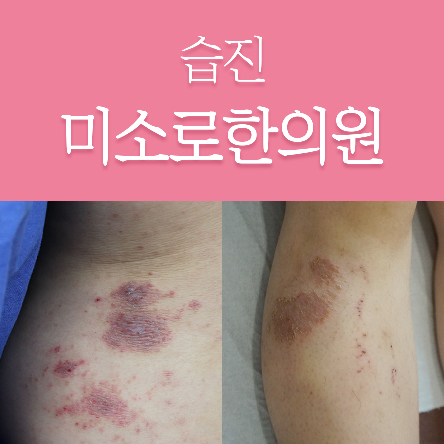 성남 엉덩이 습진 치료 관련 이미지 1