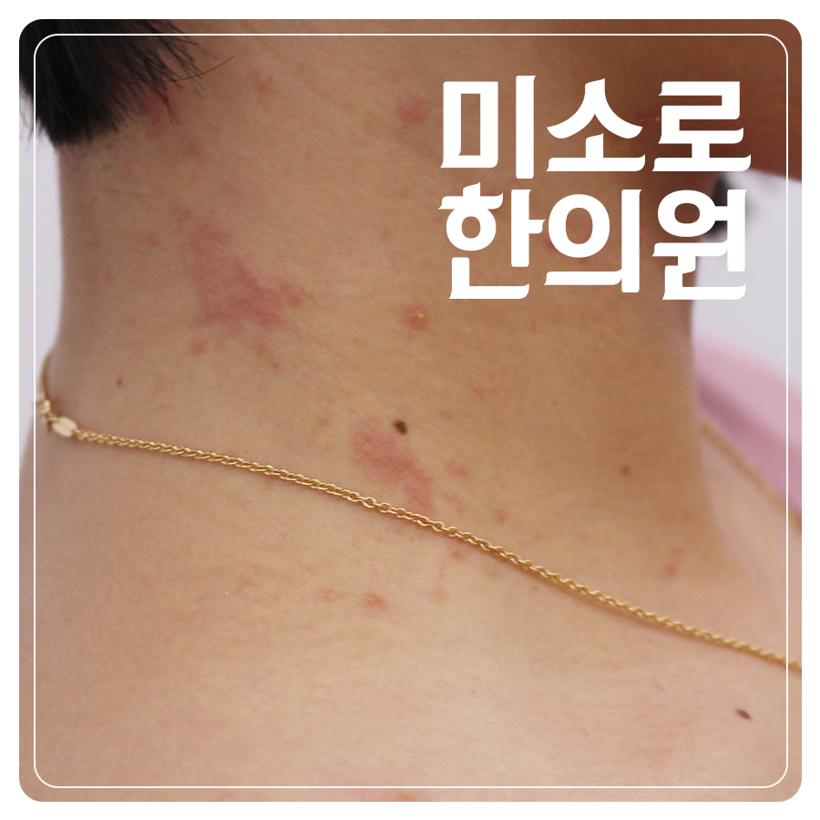 월피동 사타구니 습진 병원 어디로 관련 이미지 1