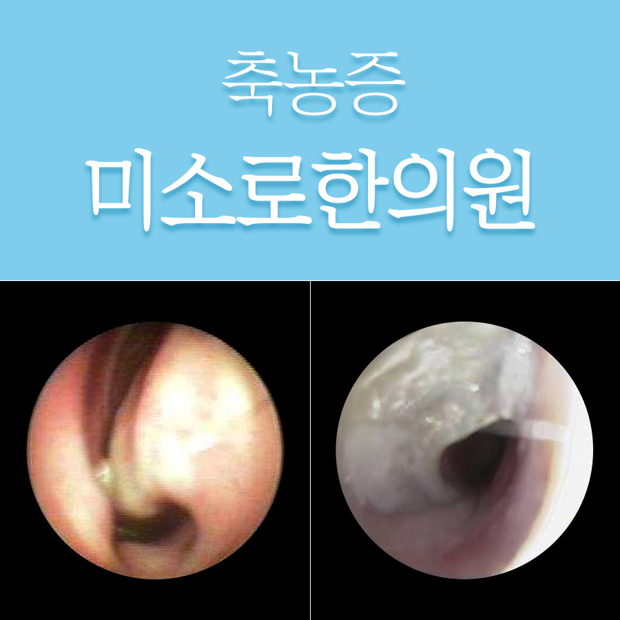 부천 만성 축농증 치료 방법 관련 이미지 1