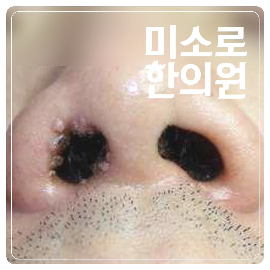분당 눈 편평사마귀 제거 관련 이미지 1